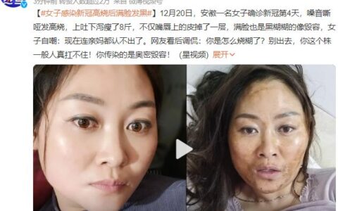 女子感染新冠高烧后满脸发黑，网友看后调侃：你是怎么烧糊了？