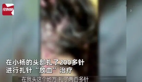 头扎200多针，女子被“放血”治疗差点丧命！