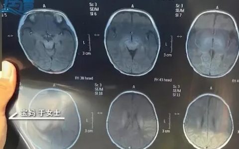 月嫂哄娃时打盹，致22天婴儿头着地摔成头顶骨骨折，平台方回应