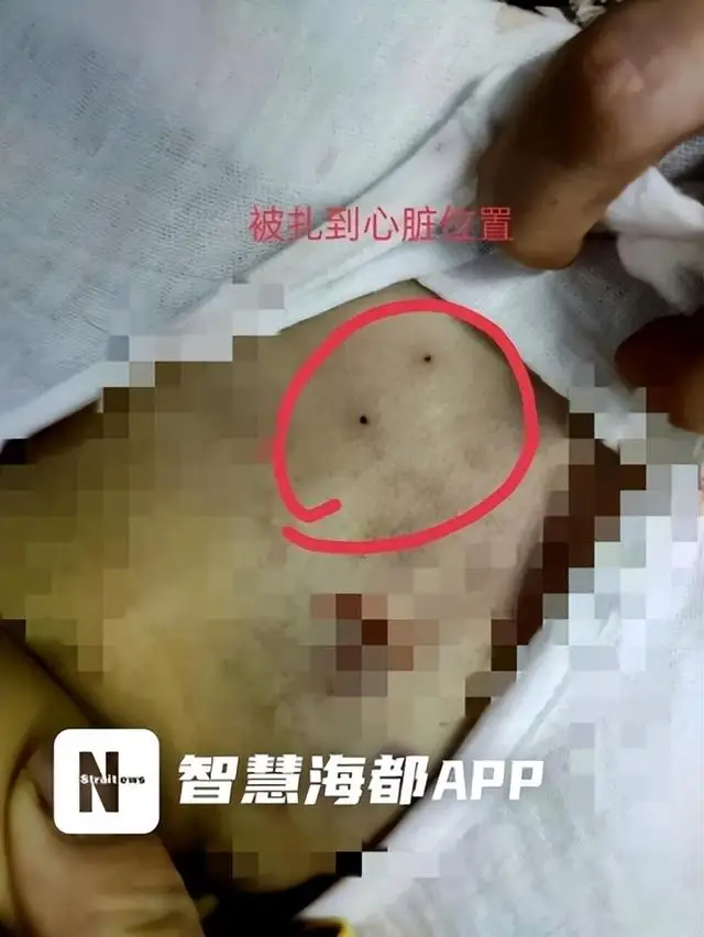 穿刺操作失误,4岁女童命丧手术台 穿刺操作失误,4岁女童命丧手术台